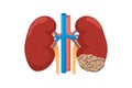 Healthy and sick kidney with cancer. Human anatomy genitourinary system internal unhealthy tumor neoplasm organ and