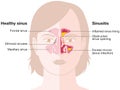 Healthy sinus and sinusitis, medical illustration Royalty Free Stock Photo
