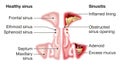 Healthy sinus and sinusitis, medical illustration, labeled