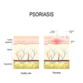 Healthy skin close up and skin with the plaque psoriasis