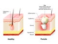 Healthy skin and Pustules