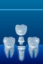 Healthy teeth and dental implant. Dentistry. Implantation of human teeth. illustration Royalty Free Stock Photo