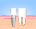 Healthy teeth and dental implant. Realistic dental implant structure with all parts: crown, abutment, screw.Dentistry. Implantati Royalty Free Stock Photo