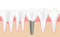 Healthy teeth and dental implant. Realistic vector illustration of tooth medical dentistry. Human teeth dental Royalty Free Stock Photo