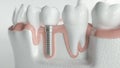 Healthy teeth and an implant - 3d rendering