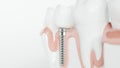 Healthy teeth and an implant - 3d rendering