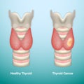 Healthy Thyroid and Thyroid Cancer. EPS10 Vector Illustration.