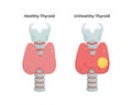 Healthy Thyroid gland and unhealthy thyroid with Inflammation and lump, thyroid cancer concept, flat illustration Royalty Free Stock Photo