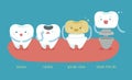 Healthy tooth ,carious ,golden tooth and crown imp