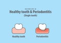 Healthy tooth & Periodontitis Single tooth illustration vector