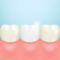 Healthy Tooth, Teeth Whitening Isolated On A Background. Realistic Vector Illustration.
