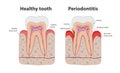 Healthy tooth and unhealthy tooth with periodontitis with gum inflammation infographic elements isolated on white