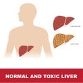 Healthy and toxic liver