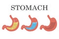 Healthy and unhealthy, empty and full human stomach, gastric juice reflux. Royalty Free Stock Photo