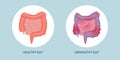 Healthy and unhealthy gut comparison Royalty Free Stock Photo