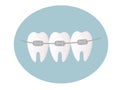 Healthy white and straight teeth with braces. Dental care service - Orthodontic treatment and straightening of teeth