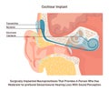 Hearing aid or cochlear implant. Surgically implanted neuroprosthesis