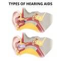 Hearing aid, in-ear sectional view, different types of devices