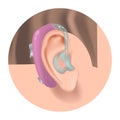 Hearing aid. Fighting deafness. Sound amplifier.