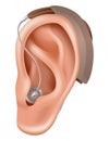 Hearing aid. Sound amplifier for patients with hearing loss. Medicine and health. Realistic object behind the ear