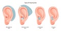 Hearing aids types set. Neuroprosthesis to a deaf person. Hearing loss