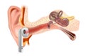 Hearing damage. Loud sound from vacuum headphones damage the inner ear. Inner ear Hearing loss.