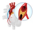 Heart Artery Bypass Grafting Royalty Free Stock Photo