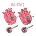 HEART ATTACK Atherosclerosis Medicine Education Vector Scheme