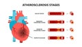 Heart attack and atherosclerosis stages. Healthy artery, beginning cholesterol plaque, advanced cholesterol plaque