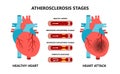 Heart attack and atherosclerosis stages. Healthy and unhealthy arteries. Cholesterol in the blood vessels.