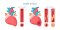 Heart attack and cardiovascular diseases infographic. Healhty and failure hearts, atherosclerosis symptoms and diagnosis. Royalty Free Stock Photo