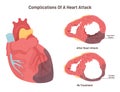 Heart attack complications. Heart wall thining and ventricle enlargening