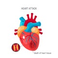 Heart attack concept in flat style, vector Royalty Free Stock Photo