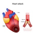 Heart attack. myocardial infarction Royalty Free Stock Photo