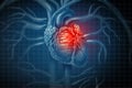 Heart Attack Medical Disease