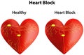 Heart Block