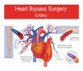 Heart bypass surgery. Royalty Free Stock Photo