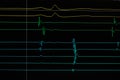 Heart cardiodiagram tracing