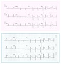 Heart Cardiogram Chart Vector. Set Healthy Heart Rhythm, Ischemia, Infarction. Vitality Heartbeat