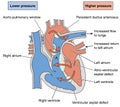 Heart defects causing Eisenmenger syndrome