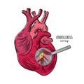 HEART DISEASE Atherosclerosis Medicine Education Vector Scheme Royalty Free Stock Photo