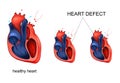 Heart disease. defect Royalty Free Stock Photo