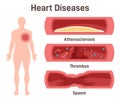 Heart disease set. Atherosclerosis, thrombus, coronary artery spasm