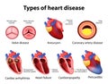 Heart disease Royalty Free Stock Photo