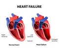Heart failure Royalty Free Stock Photo