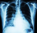 Heart failure ( film x-ray chest PA upright : show cardiomegaly and interstitial infiltrate both lung ) Royalty Free Stock Photo