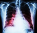 Heart failure ( film x-ray chest PA upright : show cardiomegaly and interstitial infiltrate both lung )