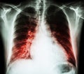 Heart failure ( film x-ray chest PA upright : show cardiomegaly and interstitial infiltrate both lung ) Royalty Free Stock Photo