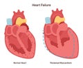 Heart failure, impairment of the blood pumping function. Healthy heart