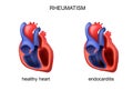 Heart healthy and diseased endocarditis Royalty Free Stock Photo